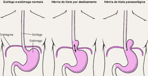 Refluxo Gastroesofágico Dr Rodrigo Nankran Cirurgia Bariátrica em